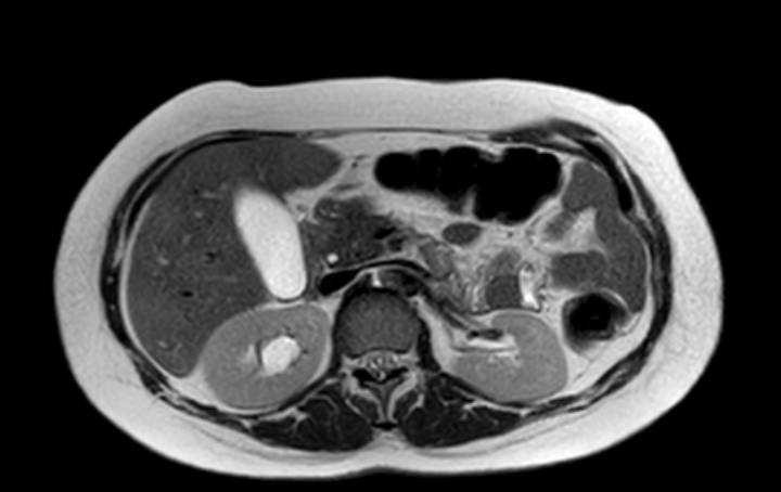 Colon adenocarcinoma with Krukenberg tumors, advanced pregnancy (Radiopaedia 67279-76645 Axial T2 56).jpg