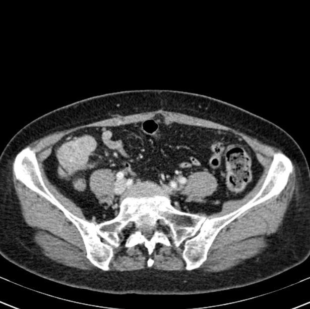 Colon carcinoma with hepatic metastases (Radiopaedia 29477-29961 A 81).jpg