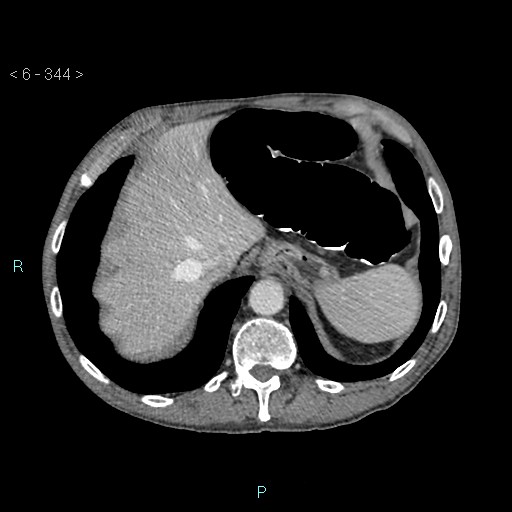 Colonic cancer (ultrasound and TC imaging) (Radiopaedia 50346-55713 B 344).jpg