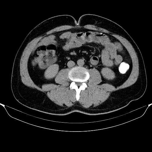 File:Colonic lipoma with colo-colic intussusception (Radiopaedia 58944-66200 Axial C+ rectal 34).jpg