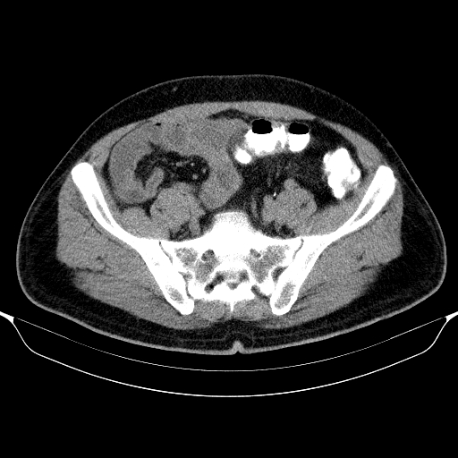 Colonic lipoma with colo-colic intussusception (Radiopaedia 58944-66200 Axial C+ rectal 53).jpg