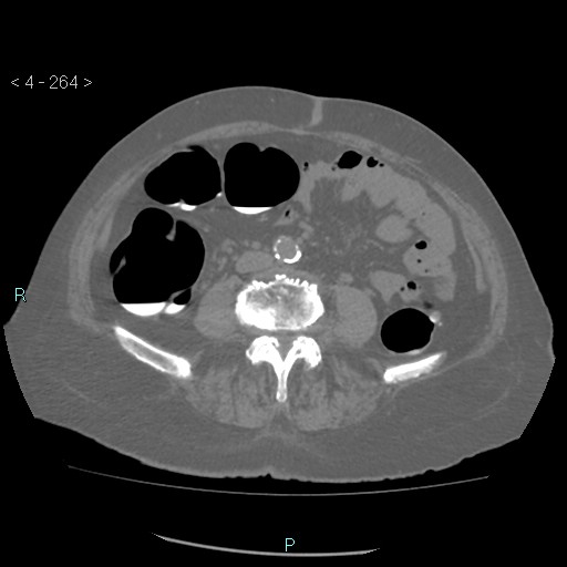 Colonic lipomas (Radiopaedia 49137-54244 Axial bone window 118).jpg