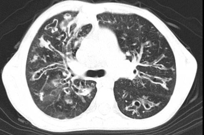 File:Cystic fibrosis (Radiopaedia 19174).jpg