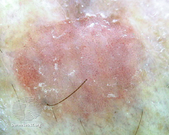 File:Dermoscopic view of squamous cell carcinoma in situ (DermNet NZ 13-scc-in-situ).jpg