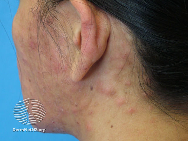 File:Eosinophilic folliculitis (DermNet NZ acne-eos-folliculitis3).jpg