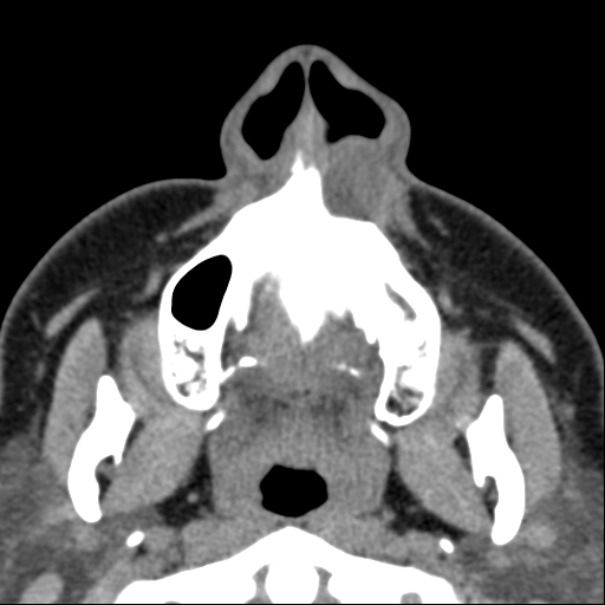Nasolabial cyst (Radiopaedia 33987-35205 Axial non-contrast 7).jpg