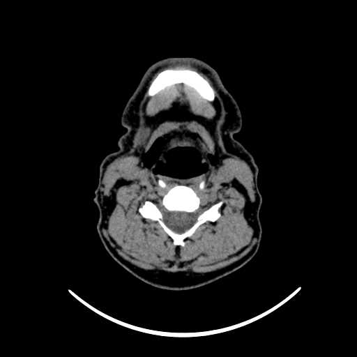 File:Nasopharyngeal carcinoma - infiltrating the clivus (Radiopaedia 62583-70875 Axial non-contrast 46).jpg