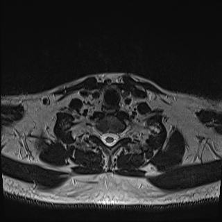Nasopharyngeal carcinoma with perineural spread (Radiopaedia 55030-61380 Axial T2 78).jpg