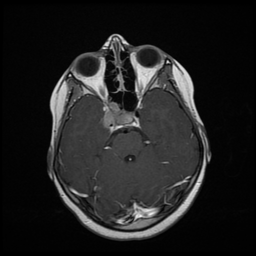 File:Nasopharyngeal rhabdomyosarcoma (Radiopaedia 23417-23486 Axial T1 C+ 12).jpg