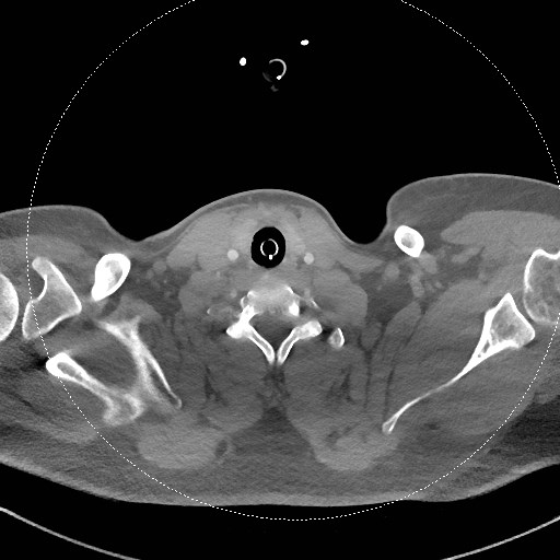 File:Neck CT angiogram (intraosseous vascular access) (Radiopaedia 55481-61945 B 130).jpg