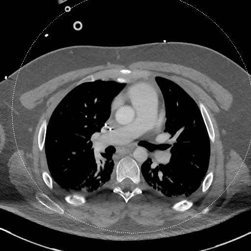 Neck CT angiogram (intraosseous vascular access) (Radiopaedia 55481-61945 B 23).jpg