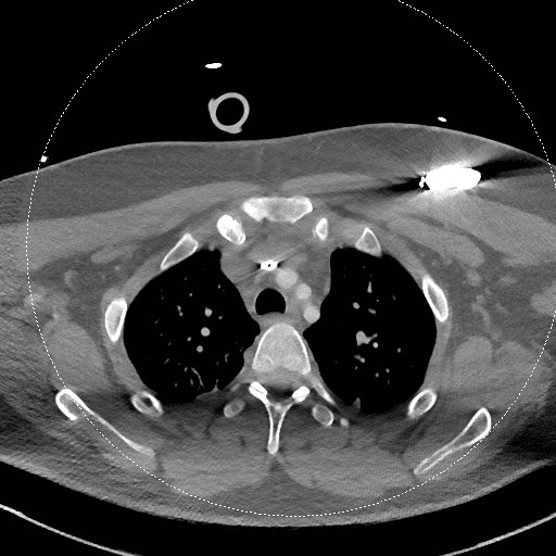 Neck CT angiogram (intraosseous vascular access) (Radiopaedia 55481-61945 B 65).jpg