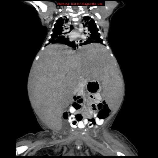 File:Neonatal neuroblastoma (Radiopaedia 9564-10223 B 70).jpg