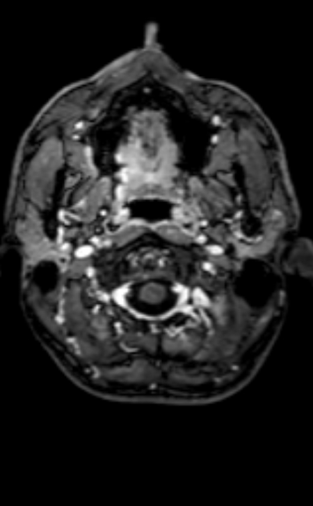 Neuro-Behçet disease (Radiopaedia 90112-107294 Axial T1 C+ 201).jpg
