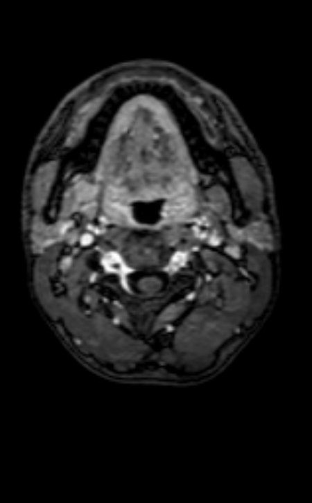 Neuro-Behçet disease (Radiopaedia 90112-107294 Axial T1 C+ 236).jpg