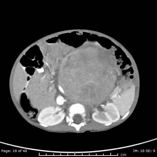 File:Neuroblastoma (Radiopaedia 41472-44355 A 18).jpg
