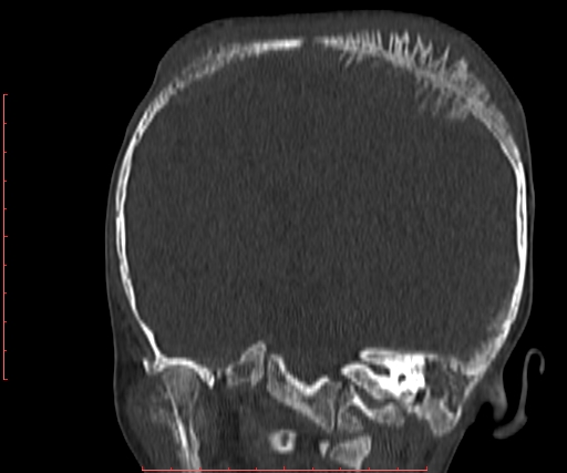 File:Neuroblastoma skull metastasis (Radiopaedia 56053-62683 Coronal bone window 21).jpg