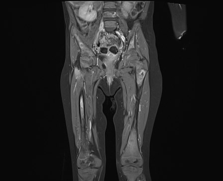 File:Neuroblastoma with bone metastases (Radiopaedia 67080-76414 E 12).jpg
