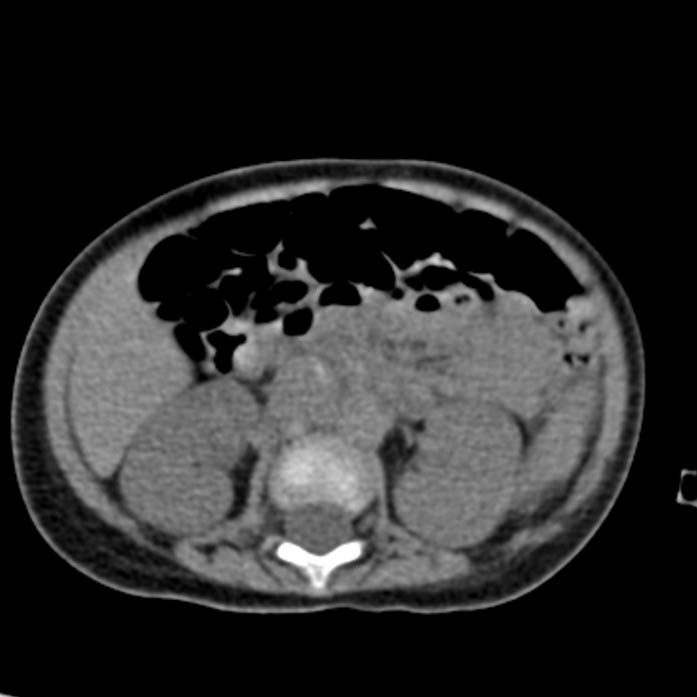 Neuroblastoma with skull metastases (Radiopaedia 30326-30960 Axial non-contrast 29).jpg