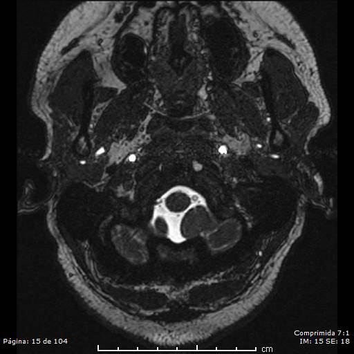Neurocysticercosis (Radiopaedia 58636-65832 I 15).jpg