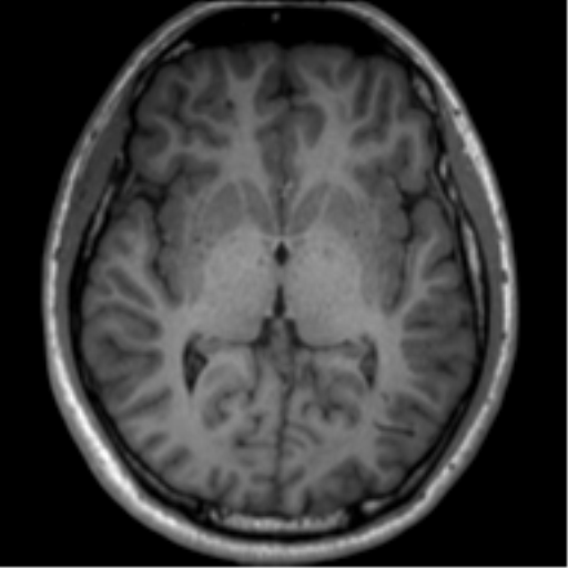 File:Neurofibromatosis type 2 (Radiopaedia 44936-48838 Axial T1 70).png