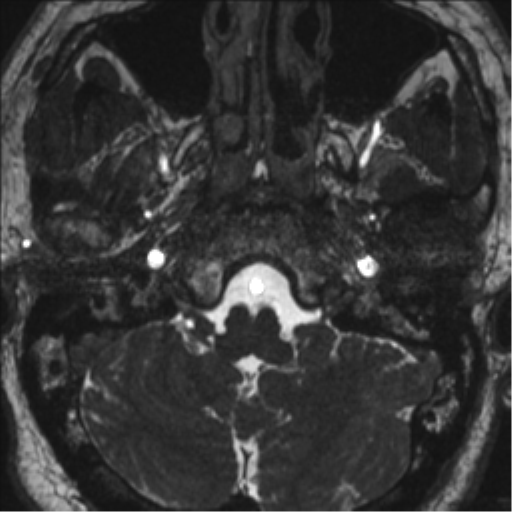 Neurofibromatosis type 2 (Radiopaedia 44936-48838 E 13).png
