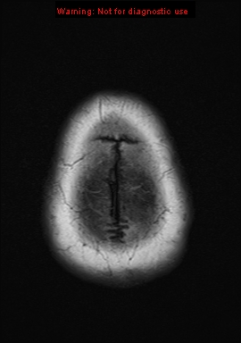 File:Neuroglial cyst (Radiopaedia 10713-11184 Axial T1 1).jpg