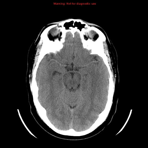 File:Neuroglial cyst (Radiopaedia 10713-11185 Axial non-contrast 20).jpg