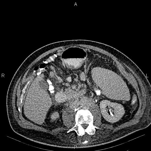 Non Hodgkin lymphoma in a patient with ankylosing spondylitis (Radiopaedia 84323-99621 Axial C+ delayed 35).jpg