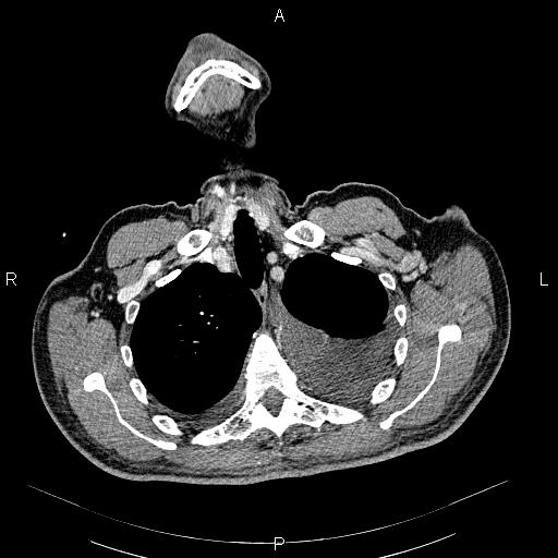 File:Non Hodgkin lymphoma in a patient with ankylosing spondylitis (Radiopaedia 84323-99621 B 8).jpg