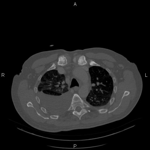 Non Hodgkin lymphoma in a patient with ankylosing spondylitis (Radiopaedia 84323-99624 Axial bone window 10).jpg