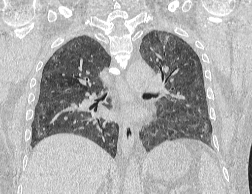 Non specific interstitial pneumonia (NSIP) (Radiopaedia 89725-106798 Coronal lung window 46).jpg