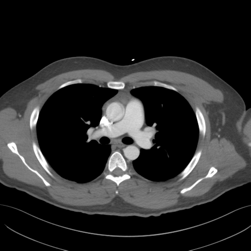 File:Normal CTA thorax (non ECG gated) (Radiopaedia 41750-44704 A 42).png