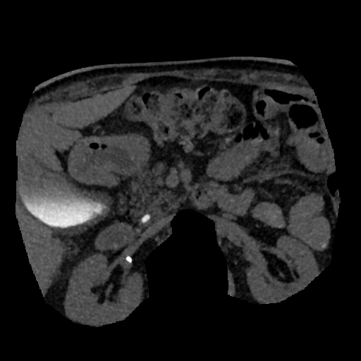 File:Normal CT intravenous cholangiogram (Radiopaedia 38199-40208 Axial IVC (MIP) 26).png