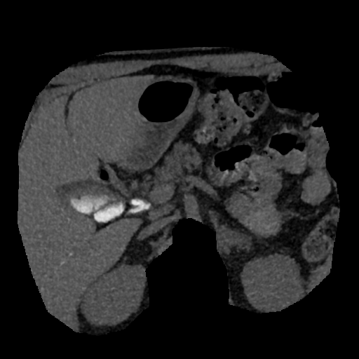 File:Normal CT intravenous cholangiogram (Radiopaedia 38199-40208 Axial IVC (MIP) 43).png