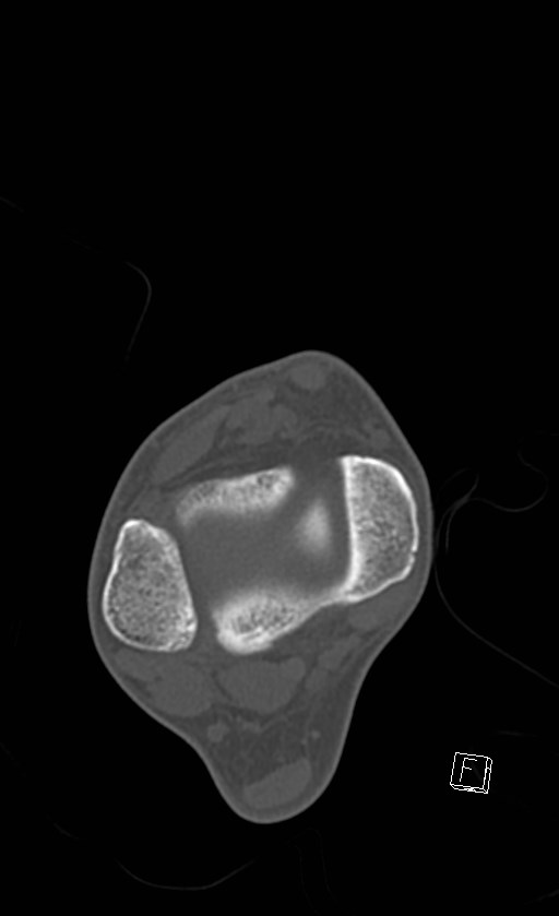 Normal CT of the ankle (Radiopaedia 47111-51658 Axial bone window 37).jpg