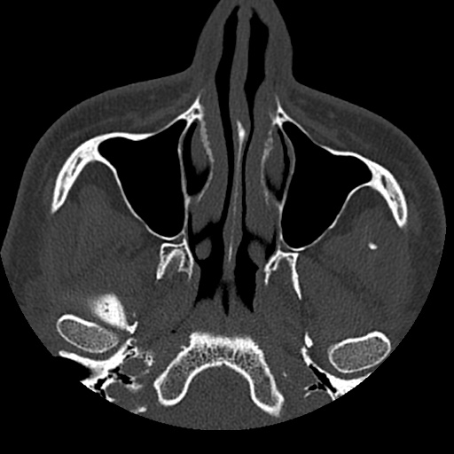 Normal CT paranasal sinuses (Radiopaedia 42286-45390 Axial bone window 78).jpg