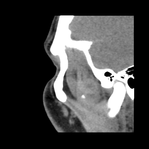Normal CT paranasal sinuses (Radiopaedia 42286-45390 F 29).jpg