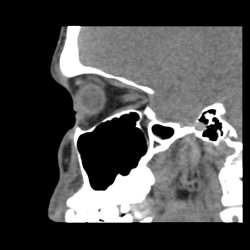 Normal CT paranasal sinuses (Radiopaedia 42286-45390 F 98).jpg