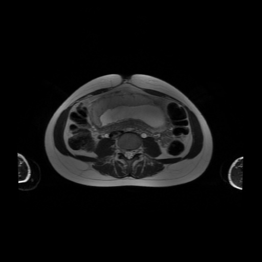 File:Normal MRI abdomen in pregnancy (Radiopaedia 88001-104541 Axial T2 38).jpg