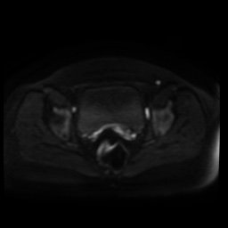 Normal MRI abdomen in pregnancy (Radiopaedia 88005-104548 Axial DWI 87).jpg