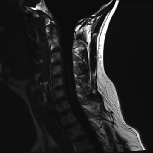 File:Normal MRI cervical spine (infection protocol) (Radiopaedia 53916-60039 F 8).png