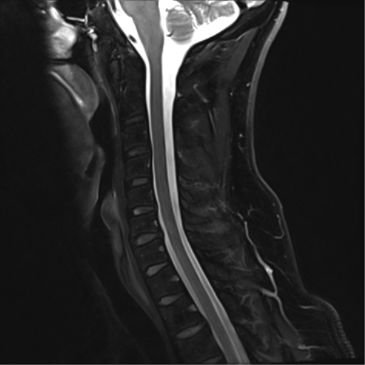 File:Normal MRI cervical spine (infection protocol) (Radiopaedia 53916-60039 Sagittal Dixon 8).png