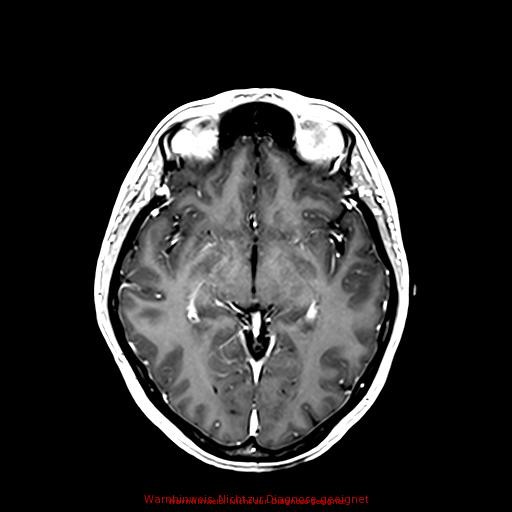 Normal adult brain MRI (non-enhanced and contrast-enhanced) (Radiopaedia 75262-86379 Axial T1 C+ 98).jpg
