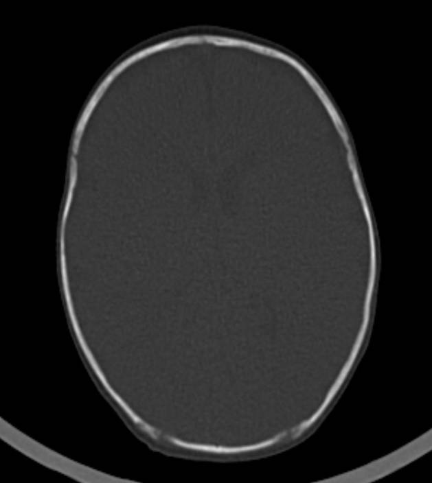 Normal brain CT - 2-month-old (Radiopaedia 53369-59350 Axial bone window 27).jpg