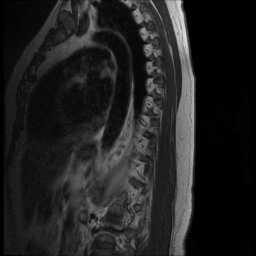 File:Normal cervical and thoracic spine MRI (Radiopaedia 35630-37156 I 1).png