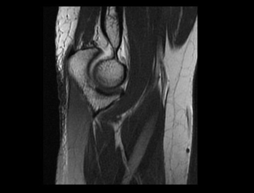 File:Normal elbow arthrograms (Radiopaedia 75550-86805 Sagittal PD 26).jpg