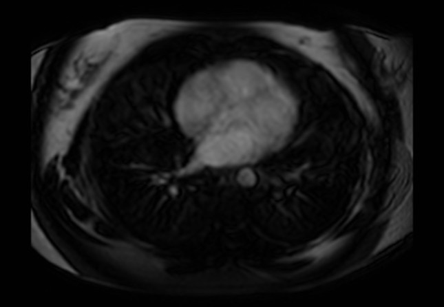 Normal liver MRI with Gadolinium (Radiopaedia 58913-66163 J 88).jpg