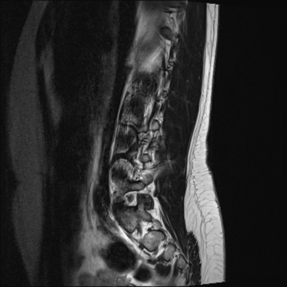 File:Normal lumbar spine MRI- 3 T (Radiopaedia 53280-59250 Sagittal T2 6).jpg