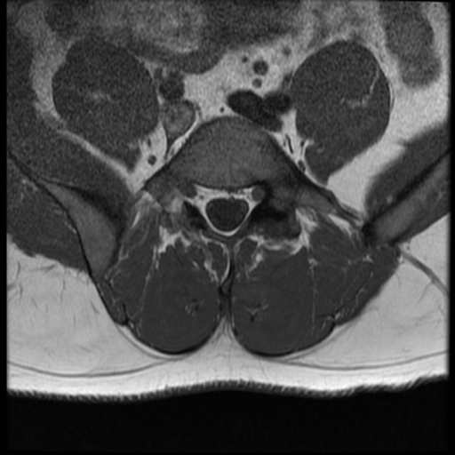 File:Normal lumbar spine MRI (Radiopaedia 35543-37039 Axial T1 10).png